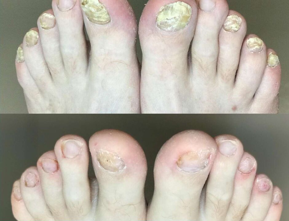 Before and after treatment, promise mushroom cream