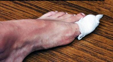 Compress to treat the fungus on the thumb of the leg