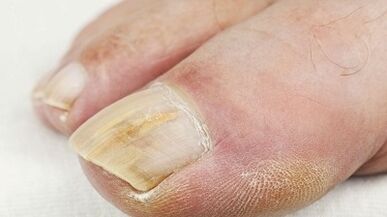 The reasons for the appearance of the fungus on the thumb of the leg