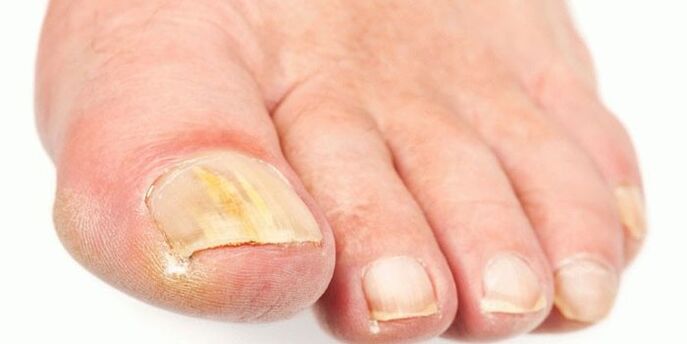 Effective nail mushrooms