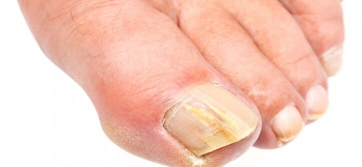 nails affected by fungus
