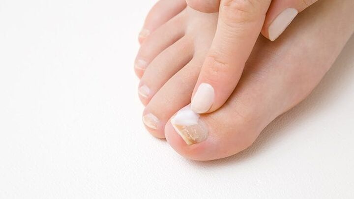 type of nail fungus