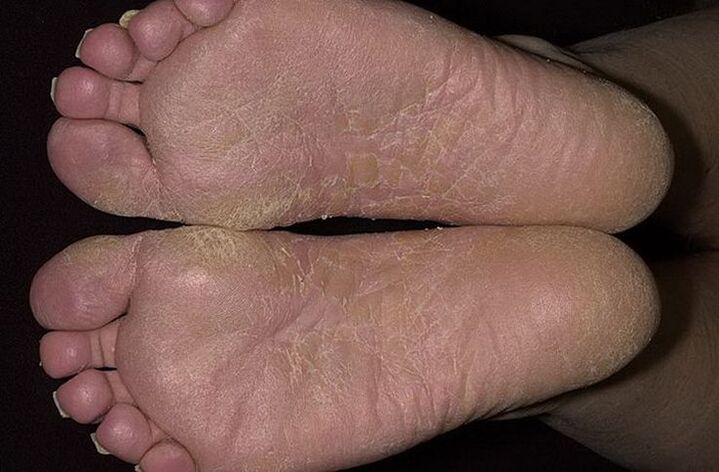 Dry, flaky skin on the feet is a sign of scaly fungus
