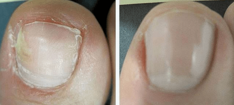 Nails before and after fungus treatment